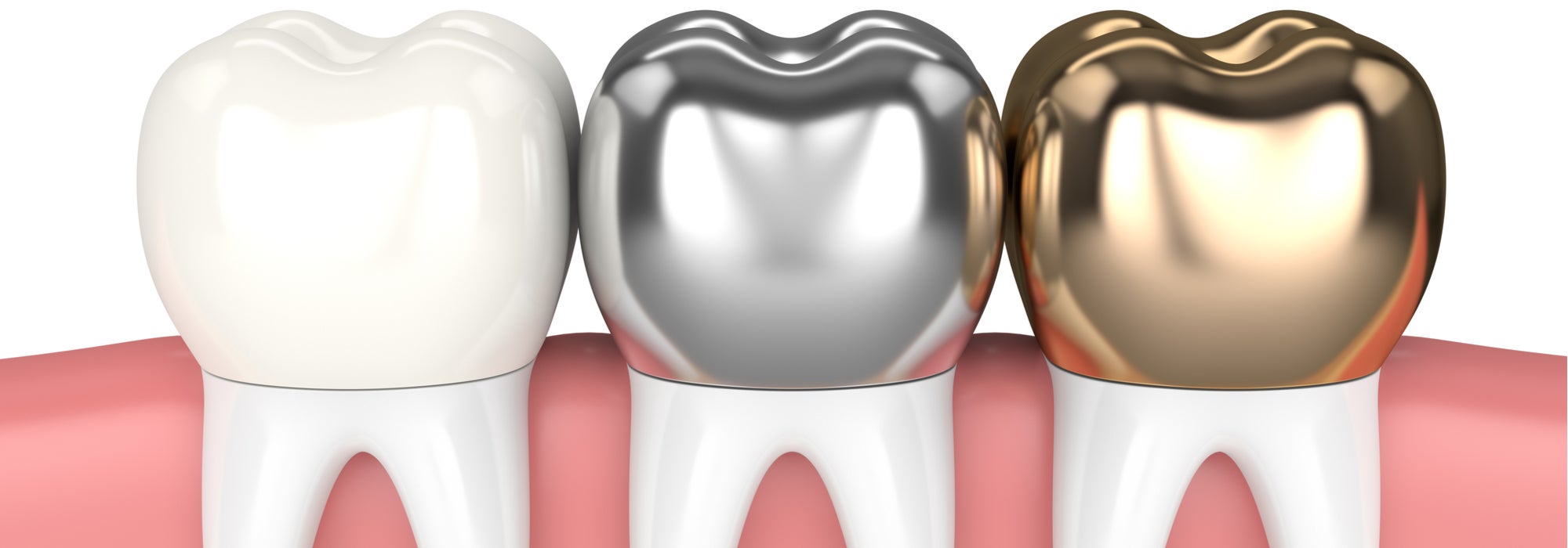 sBlog_what-are-crowns-made-of_feature_9-18