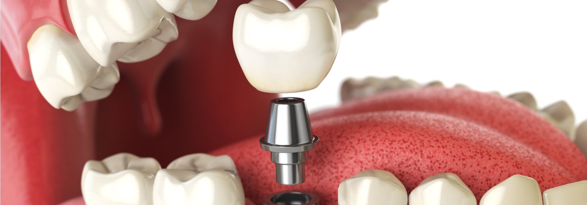 dental implant cost