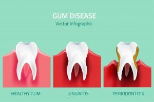 periodontics treatment