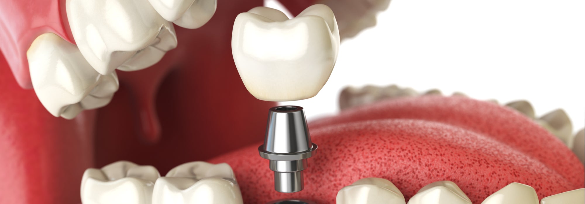 dental implant doctors
