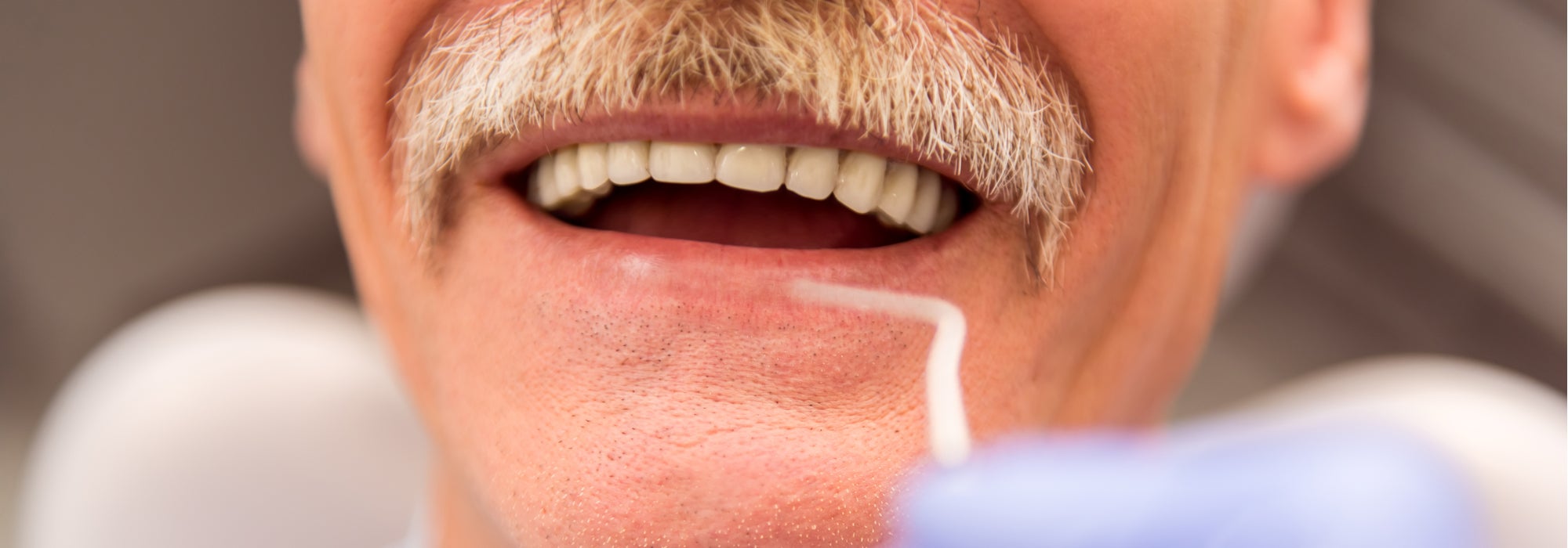 snap-in dentures cost